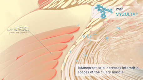 animation showing how latanoprost acid opens the interstitial spaces of the uveoscleral pathway