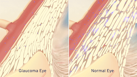animation comparing glaucoma and normal eyes showing how nitric oxide targets the primary outflow pathway to improve TM permeability